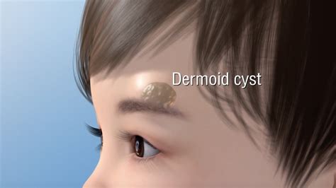 Dermoid Cyst Ablation Youtube