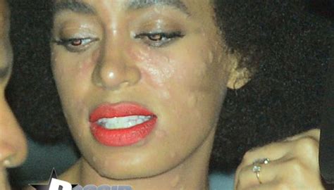Solange Broke Out In Hives Following Her New Orleans Wedding Reception