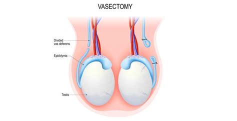 Check spelling or type a new query. Vasectomy | Urologist | UC Irvine Department of Urology