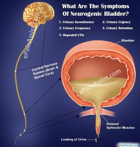 What Are The Symptoms Of Neurogenic Bladder Bladder Incontinence Overactive Bladder Chronic