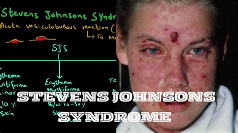 Stevens Johnsons Syndrome Erythema Multiforme Toxic Epidermal