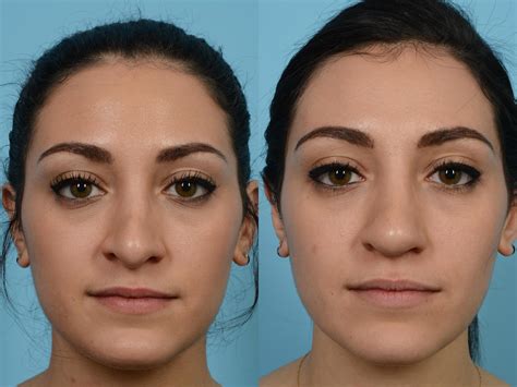 Revision Rhinoplasty Before And After Photos Patient 543 Chicago Il