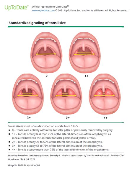 Tonsillitis Grading