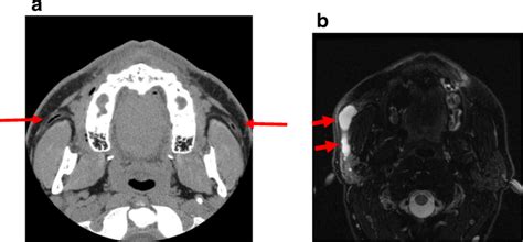 Pneumoparotid Causing Megaduct A Air Visible In Stensens Ducts