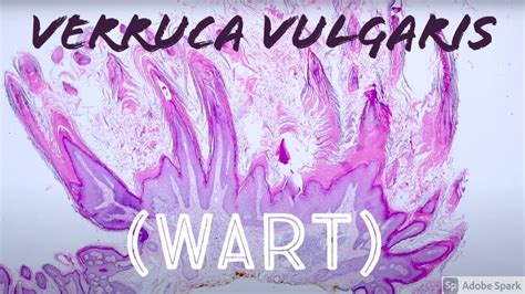 Wart Under The Microscope Verruca Vulgaris Vs Seborrheic Keratosis