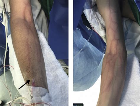 Transient Phlebitis After Propofol Infusion A Mimic Of