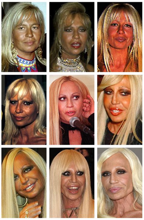 Donatella Versace Celebrity Plastic Surgery Plastic Surgery Beauty Hacks
