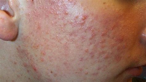 The Common Causes Of Red Tiny Itchy Bumps On Your Skin Tiny Itchy Bumps