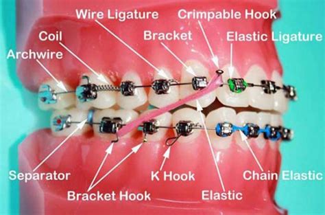 How Braces Work And The Many Types Of Braces