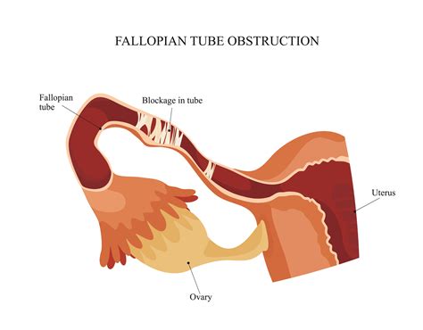 Blocked Fallopian Tube Symptoms Causes And Treatment
