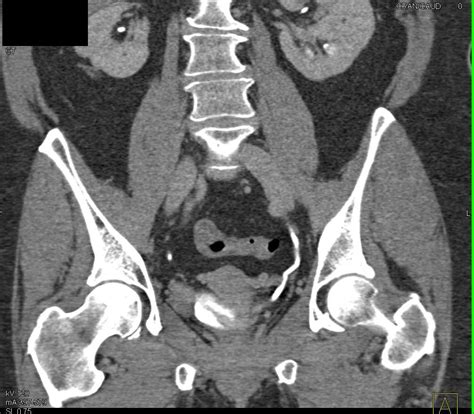 Bladder Cancer Near The Distal Right Ureterovesical Junction Uvj