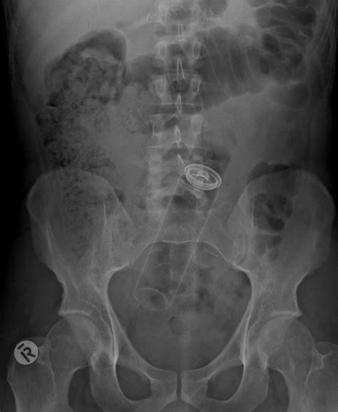 Lost And Swallowed X Rays Of Unusual Objects Inside People And Pets Irish Mirror Online