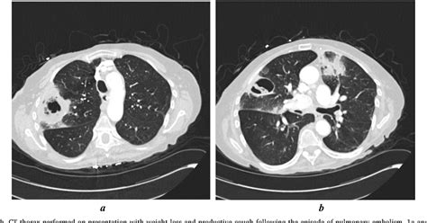 Figure 1 From Chronic Pulmonary Aspergillosis Following Pulmonary