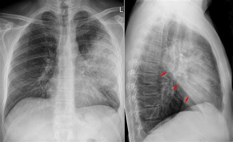 Jul 02, 2009 · le pneumocoque est l'agent infectieux le plus fréquent et fait parti des deux germes les plus graves avec legionnella pneumophila (responsable de légionellose). Pneumonie (Lungenentzündung) - Definition, Diagnose & Therapie