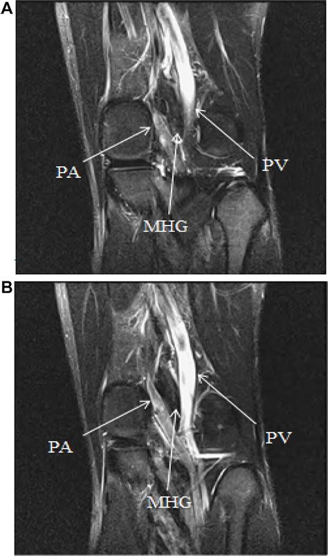 A The Left Knee Coronal T2 With Contrast Mri B The Popliteal