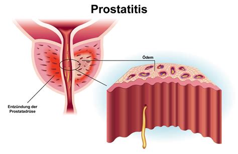 Prostatite Cos Quali Sono Le Cause E I Sintomi Mondomamma Org