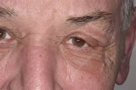 Swelling Around The Eyes Stock Image C0498266 Science Photo Library
