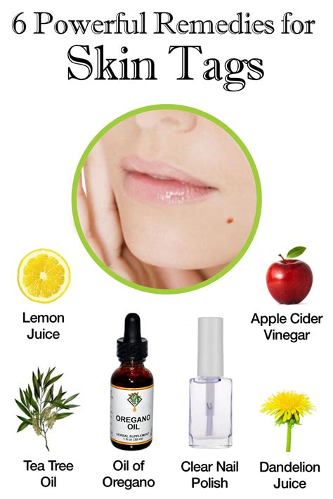 6 powerful remedies for removing skin tags artofit