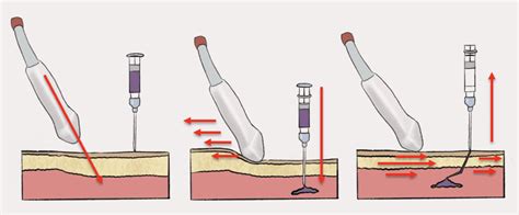 Idea Series Just In Time Training For Diagnostic Paracentesis