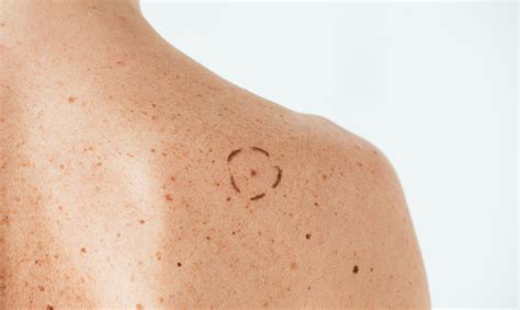 Skin Cancer Causes Risks Of Melanoma Anne Arundel Dermatology