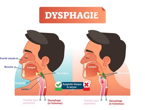 Dysphagie Trouble De La Déglutition Cause Symptômes Traitements
