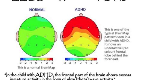 Adhd Vs Normal Brain Brain Patterns Put Adhd In Focus Australasian