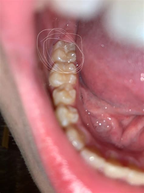 What Could Those White Spots In The Middle Of My Molars Be I See A