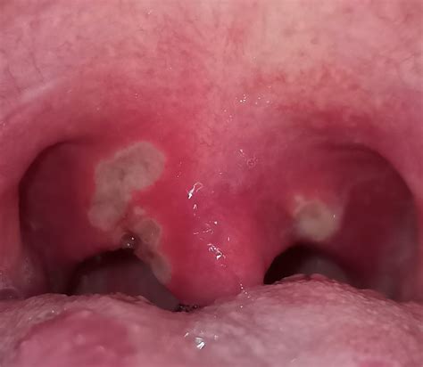 Top Pictures Photos Of Canker Sores On Tongue Superb