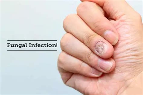 How To Get Rid Of Fungal Infection With Ayurveda Planet Ayurveda