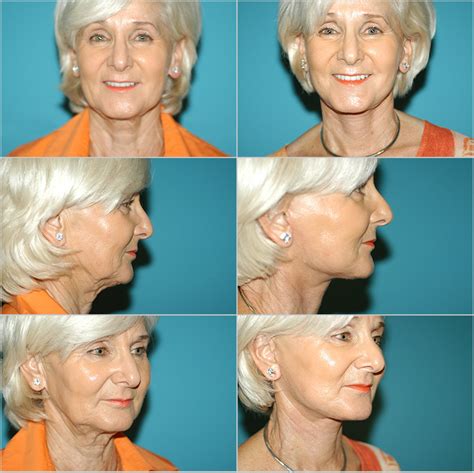 Before And After Plastic Surgery Neck Lift Naples Plastic Surgery