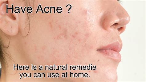 Natural Remedies For Acne Youtube