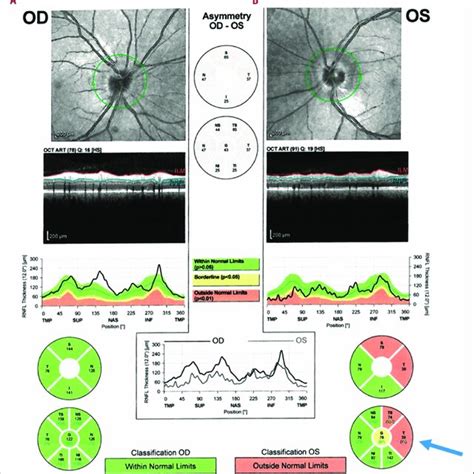 Optical Coherence Tomography Of Optic Nerve Head A Right Eye