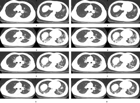 Serial Follow Up Chest Ct Scans Of The Re Hospitalized Patients Left