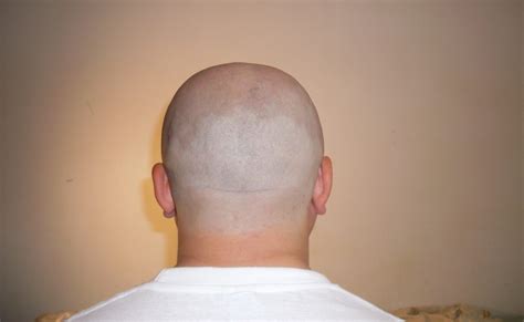 Cure For Baldness New Harvard University Study Finds Possible Cure