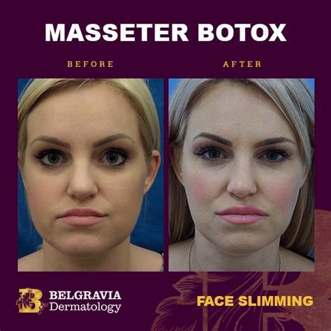 Botox For Masseter Muscles In London For Face Slimming And Teeth Grinding