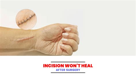 Incision Wont Heal After Surgery Bioflex Pakistan
