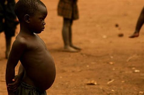Why Do Starving Peoples Stomachs Bloat Quora