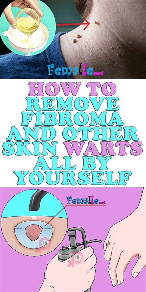 How To Remove Fibroma And Other Skin Warts All By Yourself Warts
