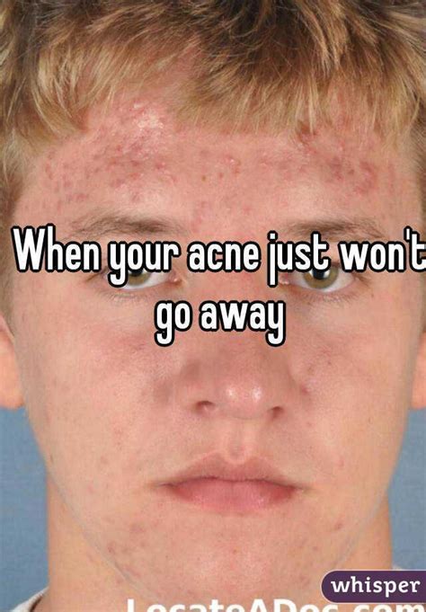 When Your Acne Just Wont Go Away
