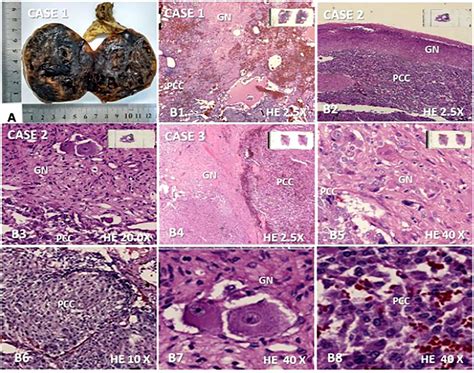 Frontiers Case Report Composite Pheochromocytoma With Ganglioneuroma