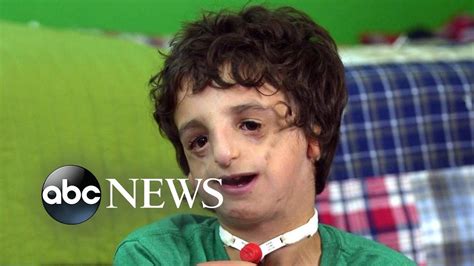 And over the years as the story kept coming back through one media form or another, and now finally the movie, this is the attention we kind of expected at the time, but it's 10 years after the fact. Boy living with Treacher Collins has 53 surgeries by age ...