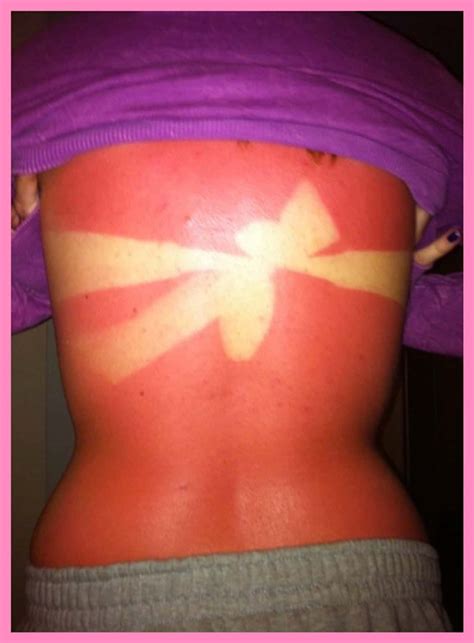 Of The Worst Sunburns