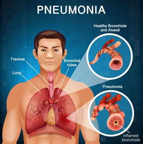 Poster Design For Pneumonia With Bad Lungs In Human Body