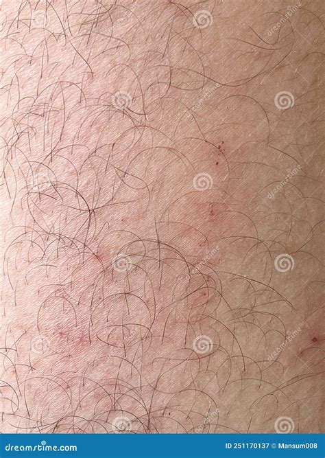 Wound On Skin Leg Stock Image Image Of Recovery Human 251170137