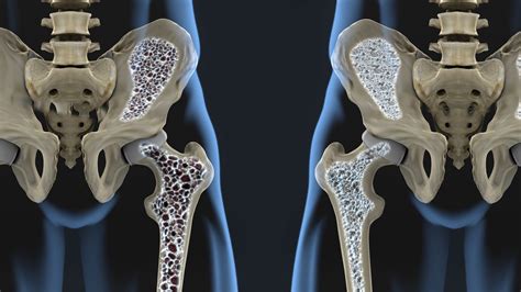 Osteoporosis Risks Symptoms And Treatment Live Science