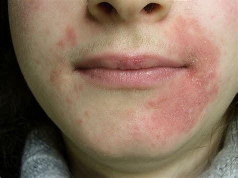 11 Skin Bumps That Look Like Pimples But Arent