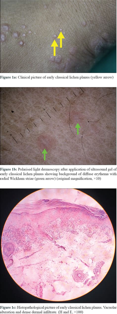 Dermoscopic Features Of Various Stages Of Lichen Planus Indian