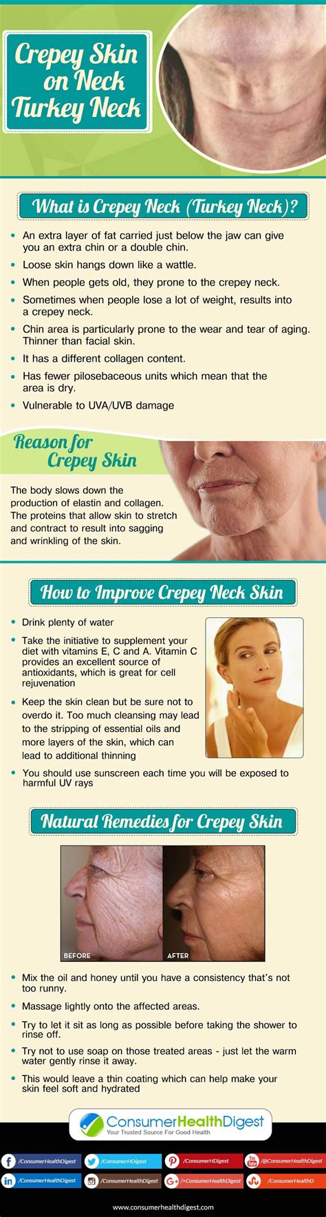 How To Improve Crepey Neck Skin