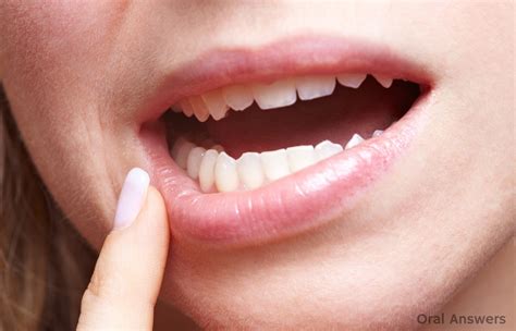 Ways To Reduce Wisdom Tooth Swelling Simply Dental