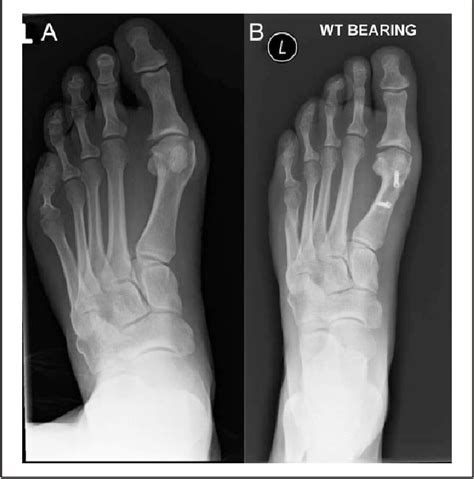 Figure 4 From Minimally Invasive Distal Metatarsal Metaphyseal Osteotomy Dmmo Of The Fifth